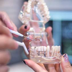 牙科义齿/增材制造